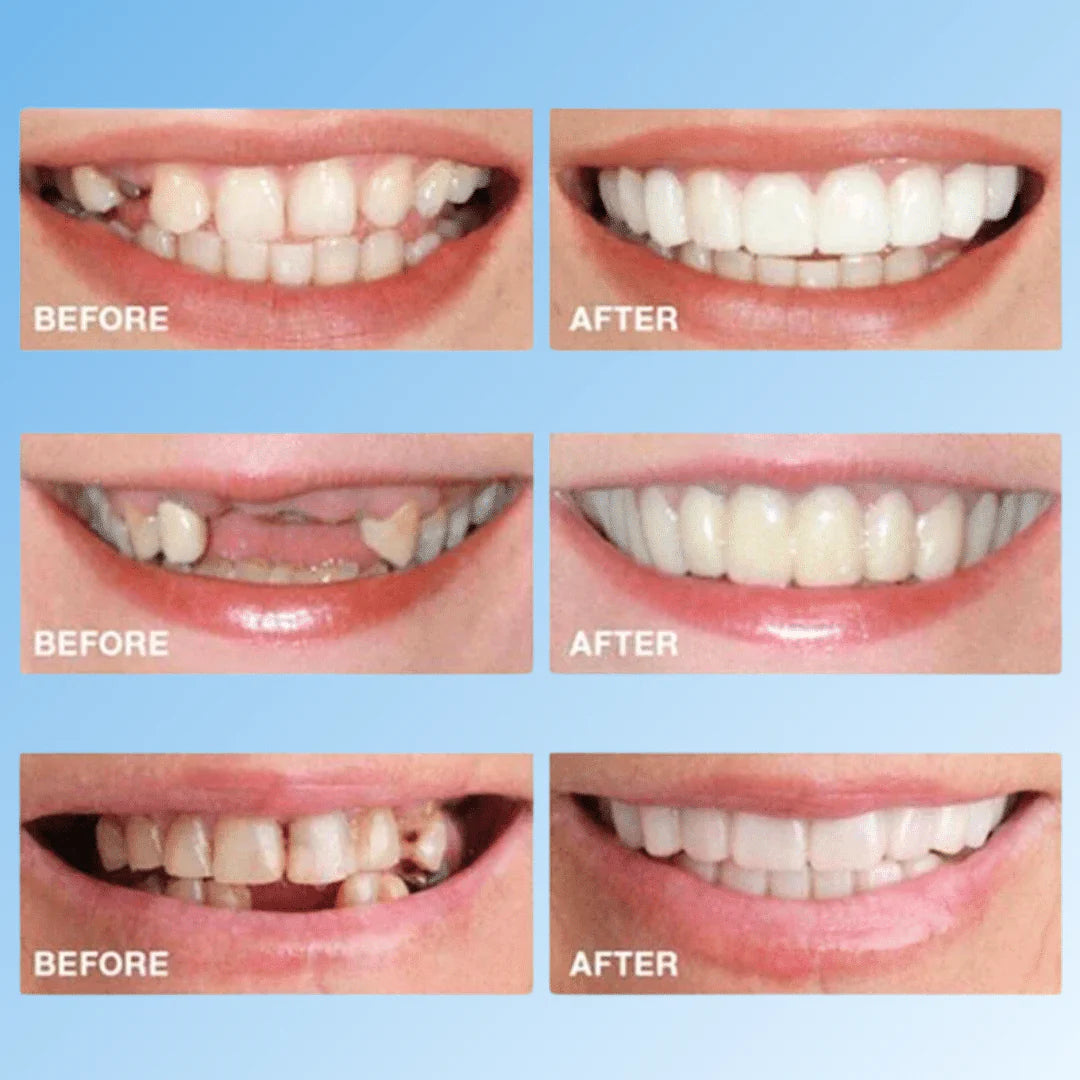 Clip-On Teeth-Veneers